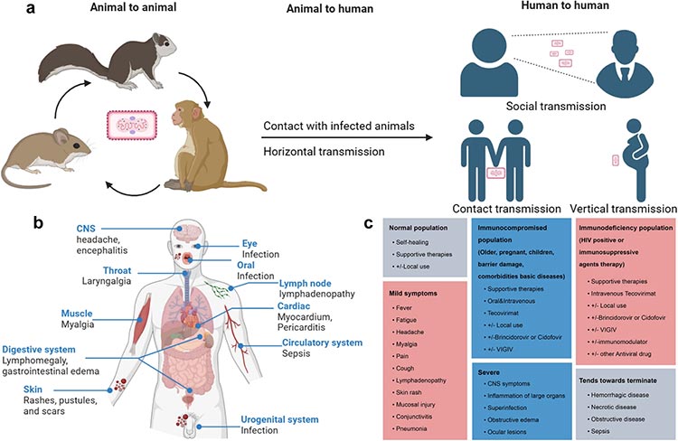 猴痘的流行病學特征、發(fā)病機制、臨床診斷和治療
